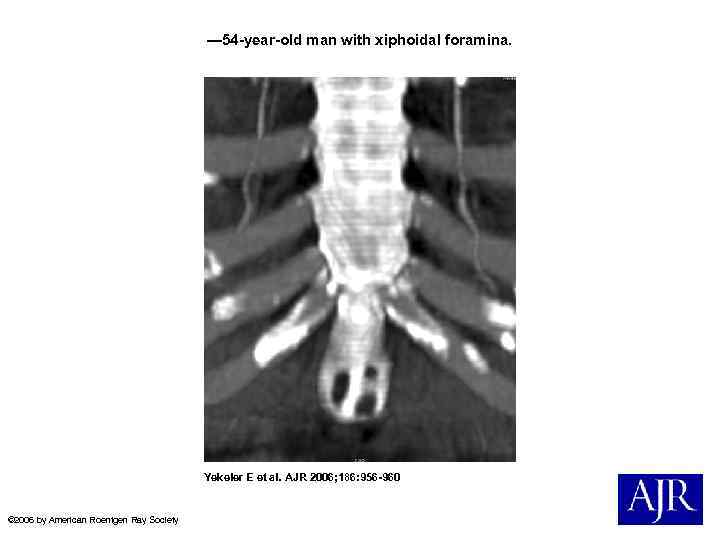 — 54 -year-old man with xiphoidal foramina. Yekeler E et al. AJR 2006; 186: