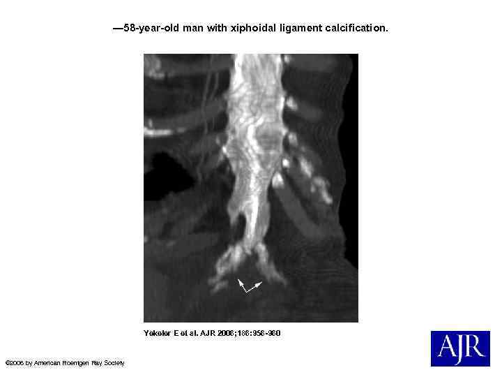 — 58 -year-old man with xiphoidal ligament calcification. Yekeler E et al. AJR 2006;