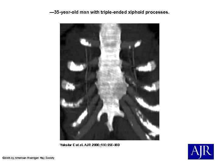 — 35 -year-old man with triple-ended xiphoid processes. Yekeler E et al. AJR 2006;