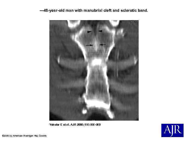 — 48 -year-old man with manubrial cleft and sclerotic band. Yekeler E et al.