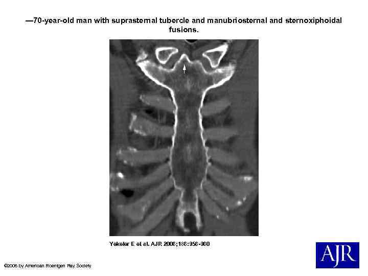 — 70 -year-old man with suprasternal tubercle and manubriosternal and sternoxiphoidal fusions. Yekeler E