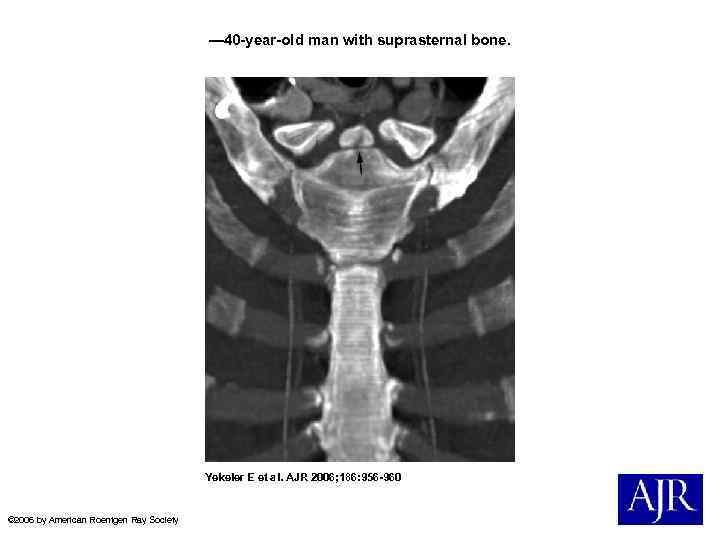 — 40 -year-old man with suprasternal bone. Yekeler E et al. AJR 2006; 186: