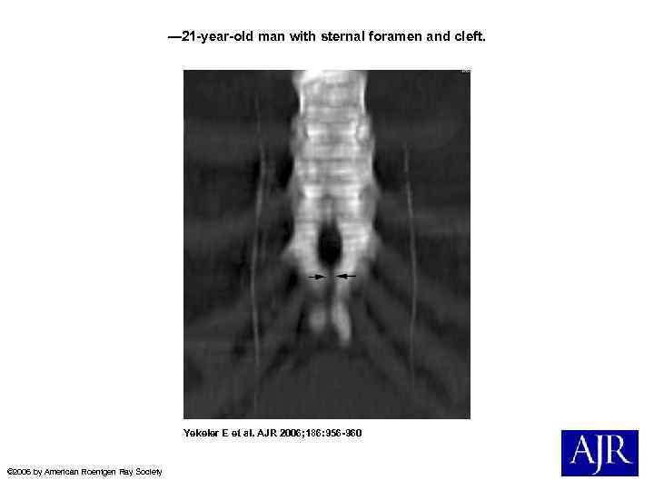 — 21 -year-old man with sternal foramen and cleft. Yekeler E et al. AJR