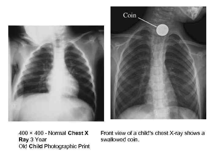 400 × 400 - Normal Chest X Ray 3 Year Old Child Photographic Print