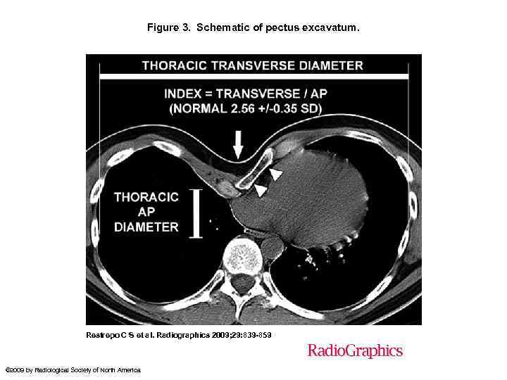 Figure 3. Schematic of pectus excavatum. Restrepo C S et al. Radiographics 2009; 29: