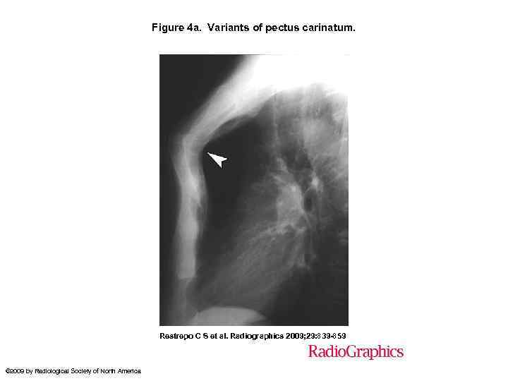 Figure 4 a. Variants of pectus carinatum. Restrepo C S et al. Radiographics 2009;