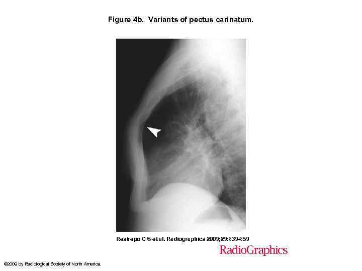 Figure 4 b. Variants of pectus carinatum. Restrepo C S et al. Radiographics 2009;