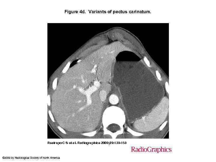 Figure 4 d. Variants of pectus carinatum. Restrepo C S et al. Radiographics 2009;