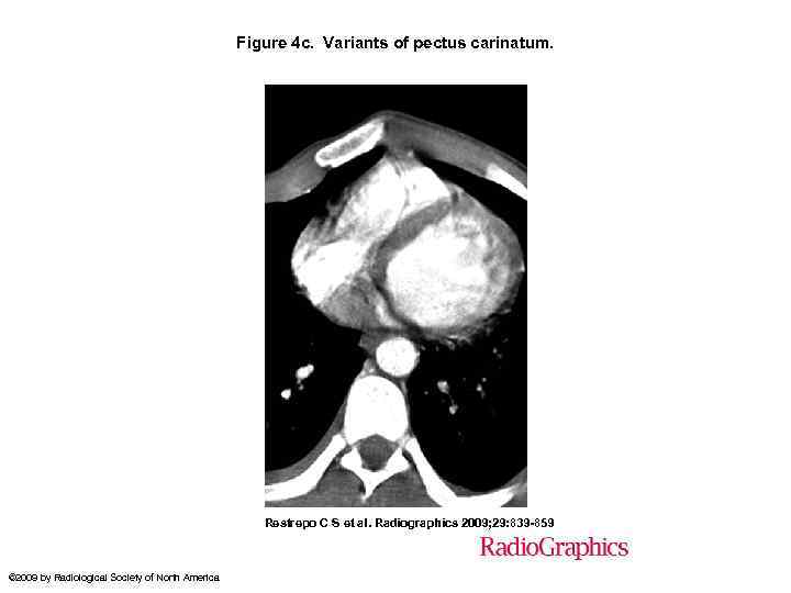 Figure 4 c. Variants of pectus carinatum. Restrepo C S et al. Radiographics 2009;