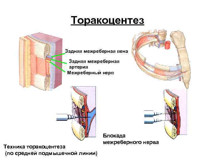 Торакоцентез Задняя межреберная вена Задняя межреберная артерия Межреберный нерв Техника торакоцентеза (по средней подмышечной