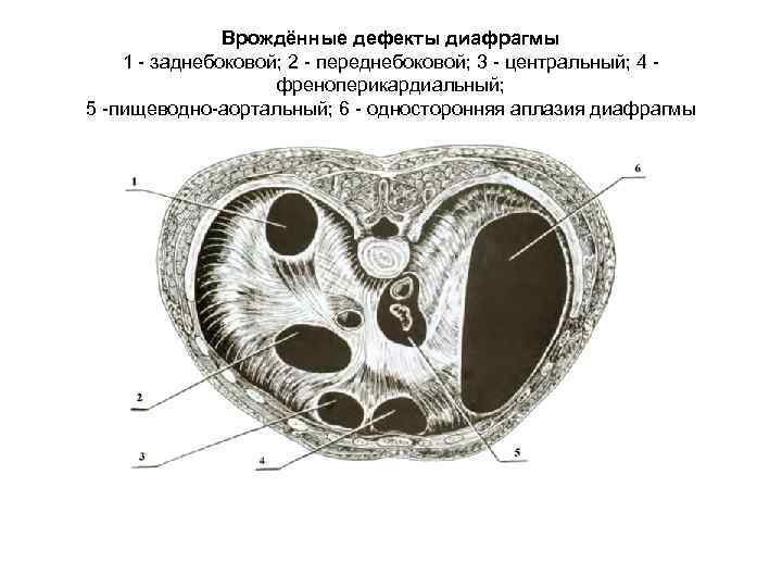 Врождённые дефекты диафрагмы 1 - заднебоковой; 2 - переднебоковой; 3 - центральный; 4 френоперикардиальный;