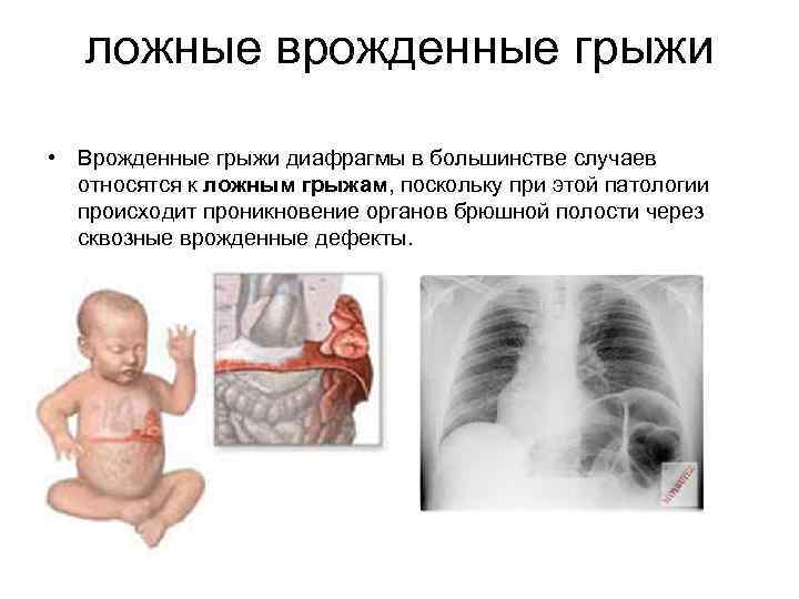 ложные врожденные грыжи • Врожденные грыжи диафрагмы в большинстве случаев относятся к ложным грыжам,