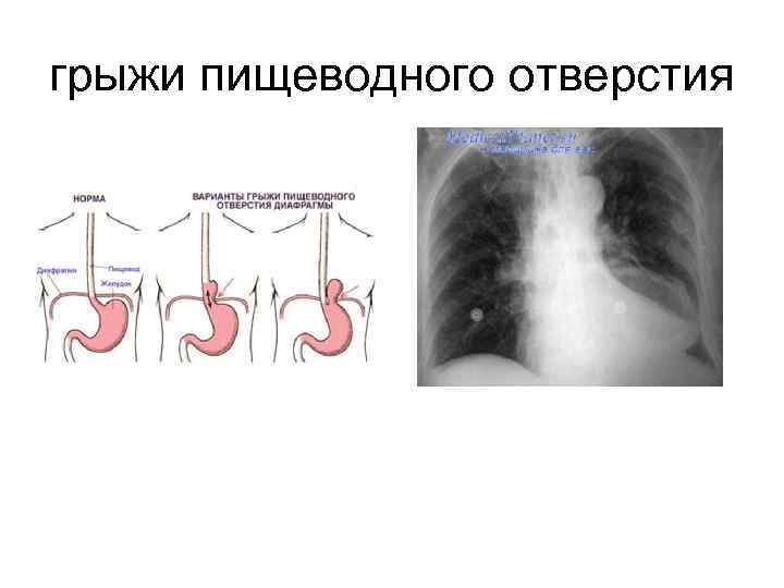 грыжи пищеводного отверстия 