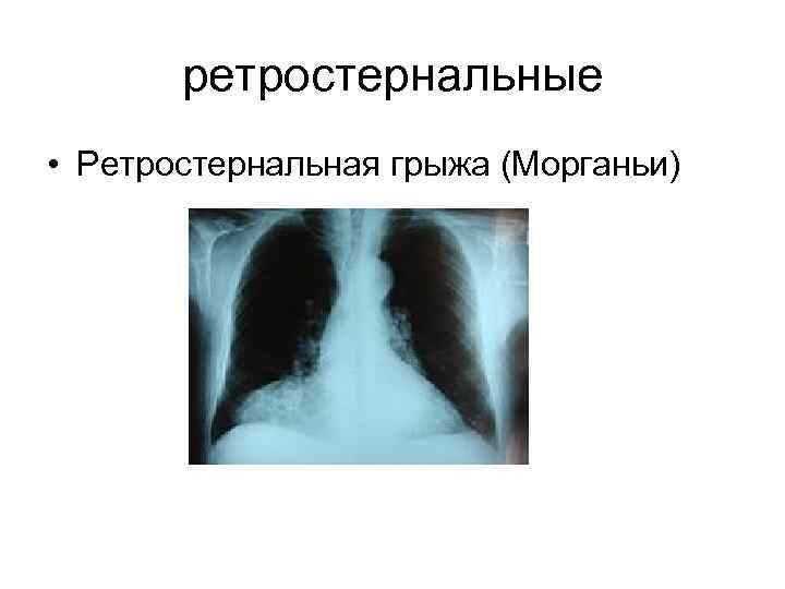 ретростернальные • Ретростернальная грыжа (Морганьи) 