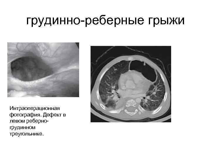 грудинно-реберные грыжи Интраоперационная фотография. Дефект в левом реберногрудинном треугольнике. 