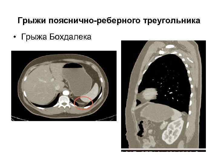 Грыжи пояснично-реберного треугольника • Грыжа Бохдалека 