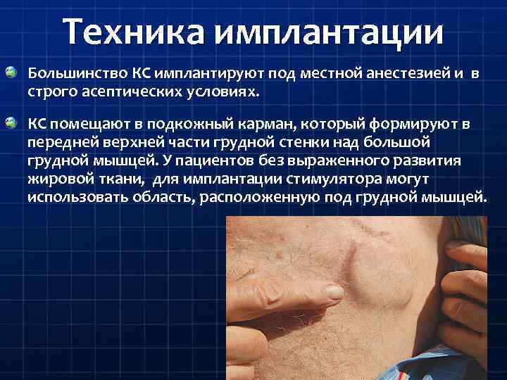 Техника имплантации Большинство КС имплантируют под местной анестезией и в строго асептических условиях. КС
