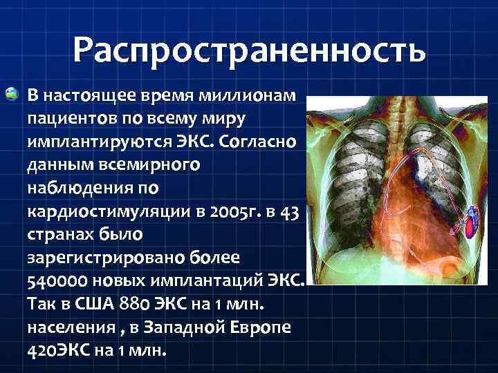 Распространенность В настоящее время миллионам пациентов по всему миру имплантируются ЭКС. Согласно данным всемирного