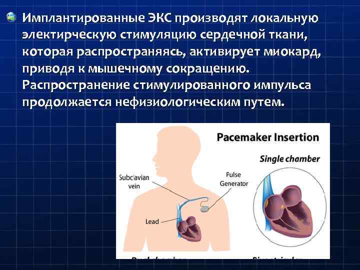 Имплантированные ЭКС производят локальную электирческую стимуляцию сердечной ткани, которая распространяясь, активирует миокард, приводя к