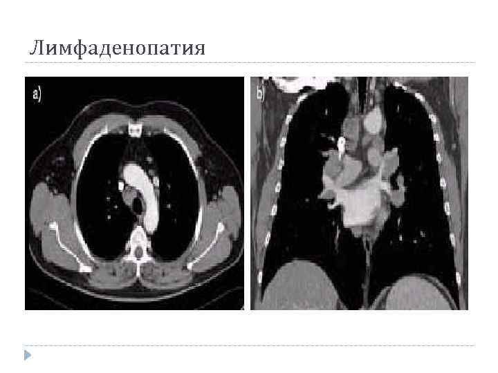 Лимфаденопатия 