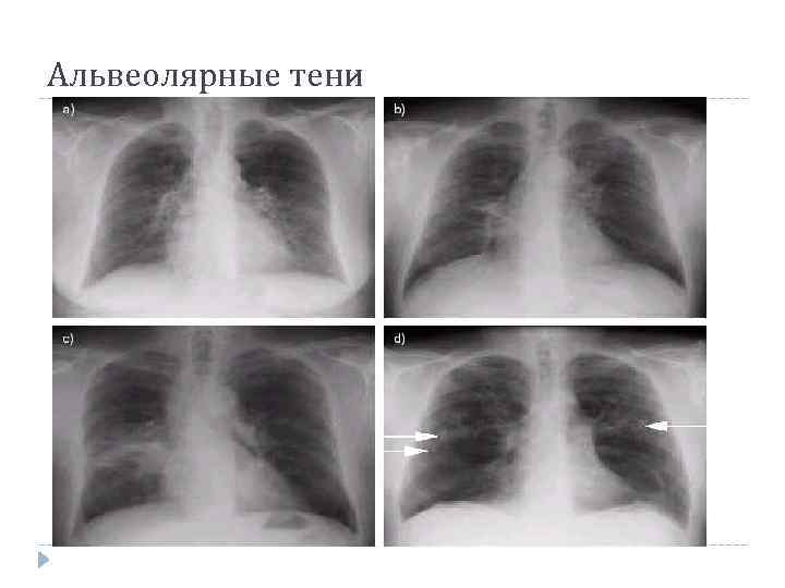 Альвеолярные тени 
