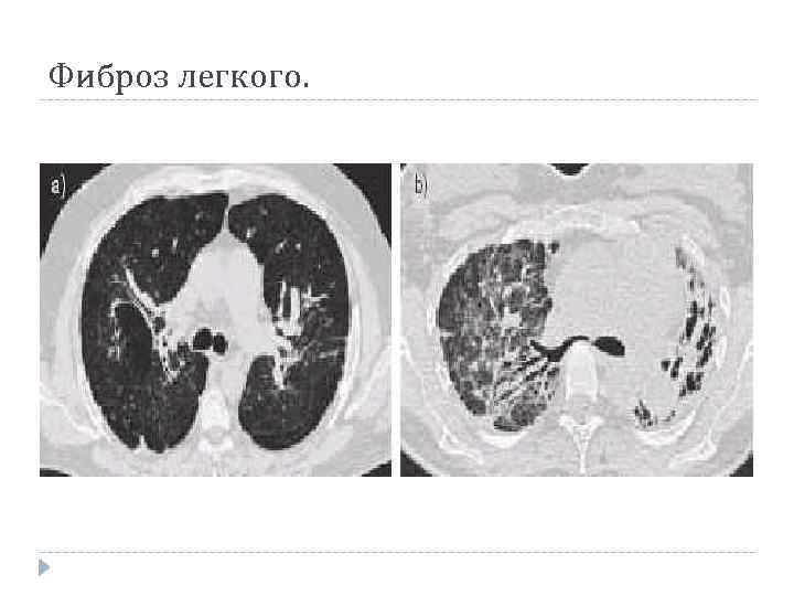 Фиброз легкого. 