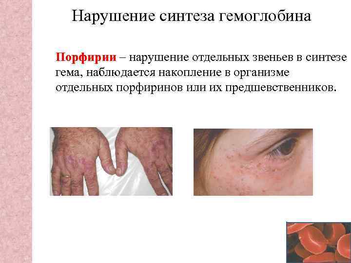 Нарушение синтеза гемоглобина Порфирии – нарушение отдельных звеньев в синтезе гема, наблюдается накопление в
