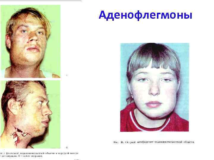 Аденофлегмоны 