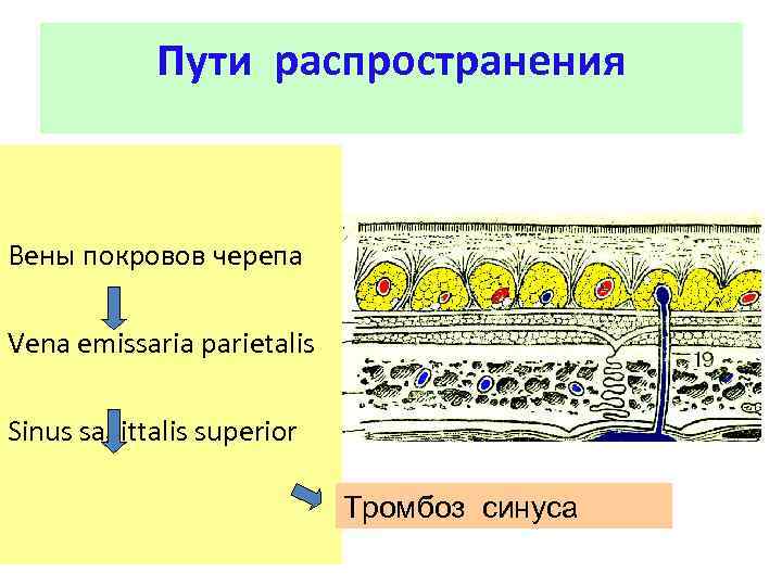 Пути распространения Вены покровов черепа Vena emissaria parietalis Sinus sagittalis superior Тромбоз синуса 