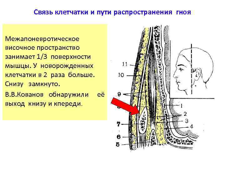 Связь клетчатки и пути распространения гноя Межапоневротическое височное пространство занимает 1/3 поверхности мышцы. У
