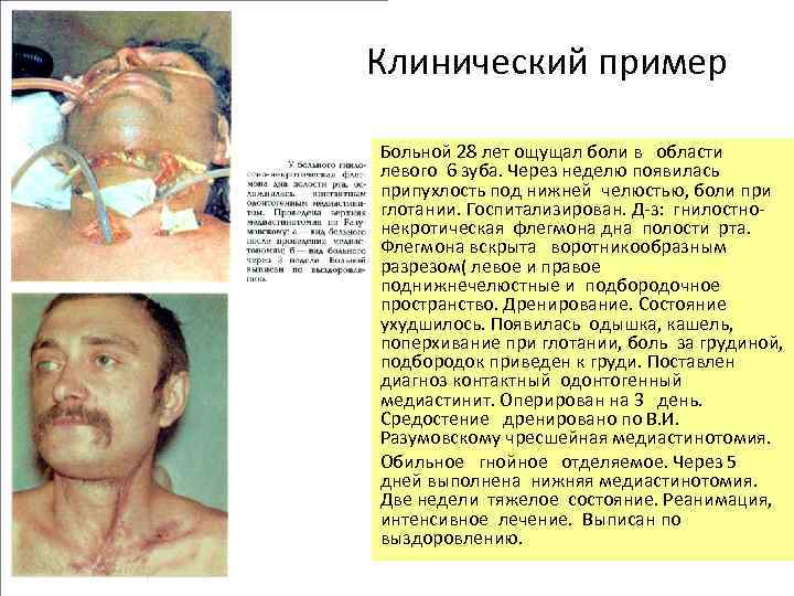Клинический пример Больной 28 лет ощущал боли в области левого 6 зуба. Через неделю