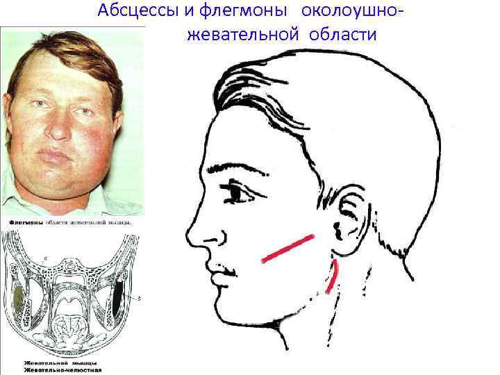 Абсцессы и флегмоны околоушножевательной области 