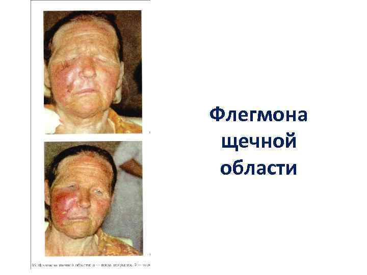 Флегмона щечной области 