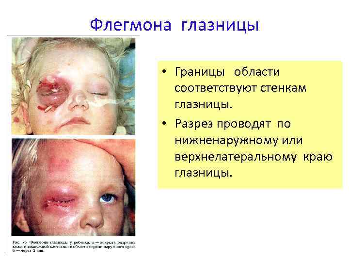 Флегмона глазницы • Границы области соответствуют стенкам глазницы. • Разрез проводят по нижненаружному или