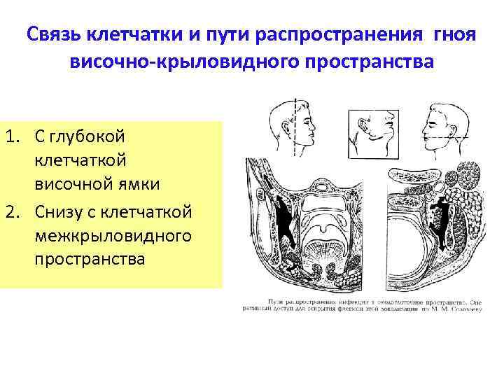 Связь клетчатки и пути распространения гноя височно-крыловидного пространства 1. С глубокой клетчаткой височной ямки
