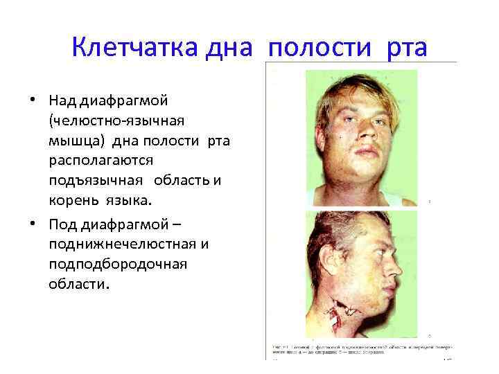 Клетчатка дна полости рта • Над диафрагмой (челюстно-язычная мышца) дна полости рта располагаются подъязычная