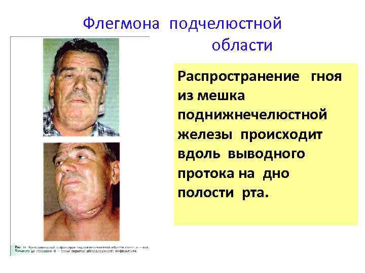 Флегмона подчелюстной области Распространение гноя из мешка поднижнечелюстной железы происходит вдоль выводного протока на