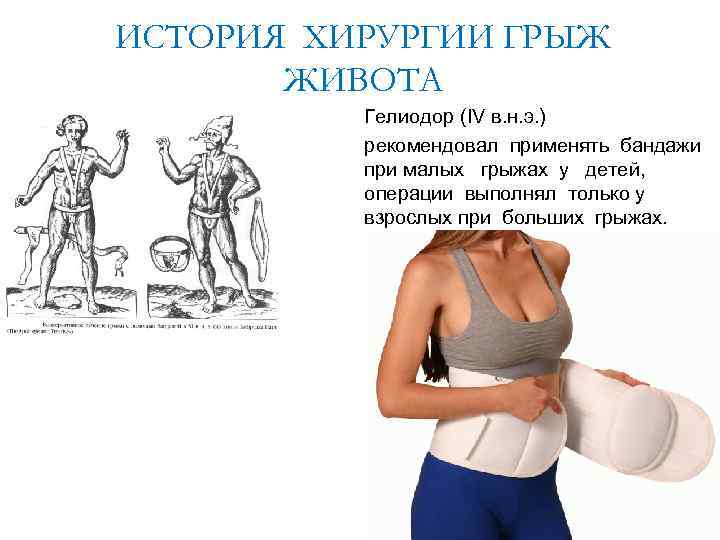 ИСТОРИЯ ХИРУРГИИ ГРЫЖ ЖИВОТА Гелиодор (IV в. н. э. ) рекомендовал применять бандажи при