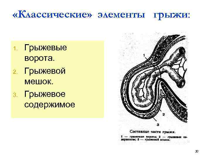 Паховая грыжа у детей презентация