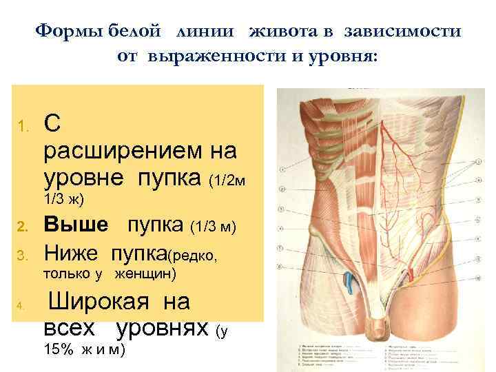 Формы белой линии живота в зависимости от выраженности и уровня: 1. С расширением на