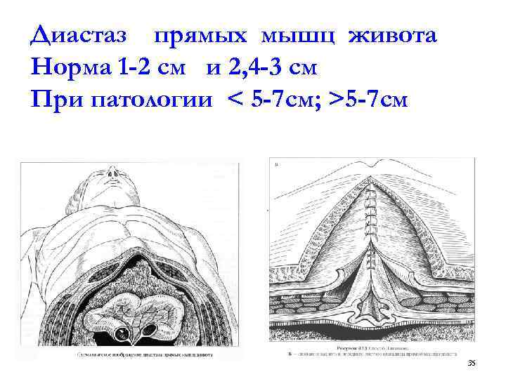 Диастаз прямых мышц