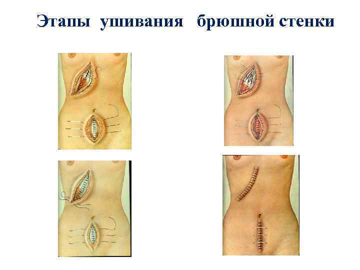 Этапы ушивания брюшной стенки 