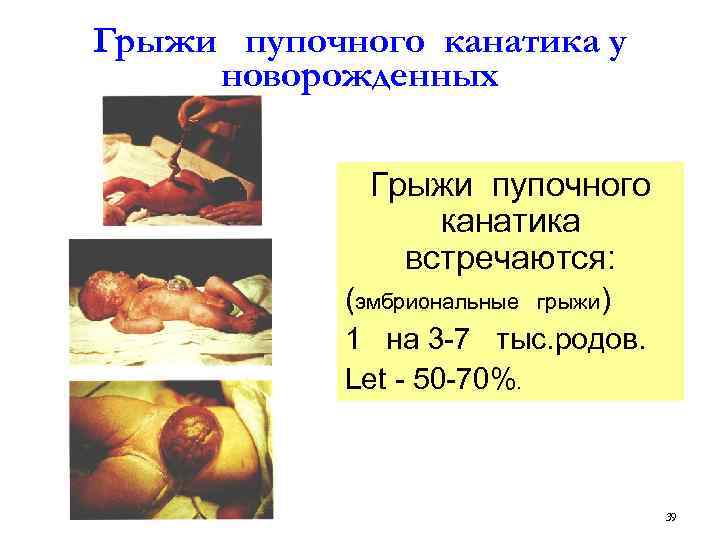 Грыжи пупочного канатика у новорожденных Грыжи пупочного канатика встречаются: (эмбриональные грыжи) 1 на 3