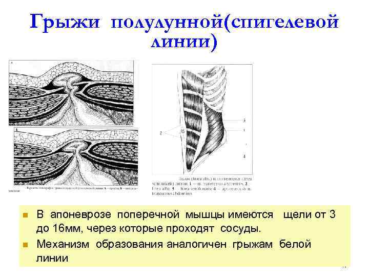 Грыжа белой линии живота