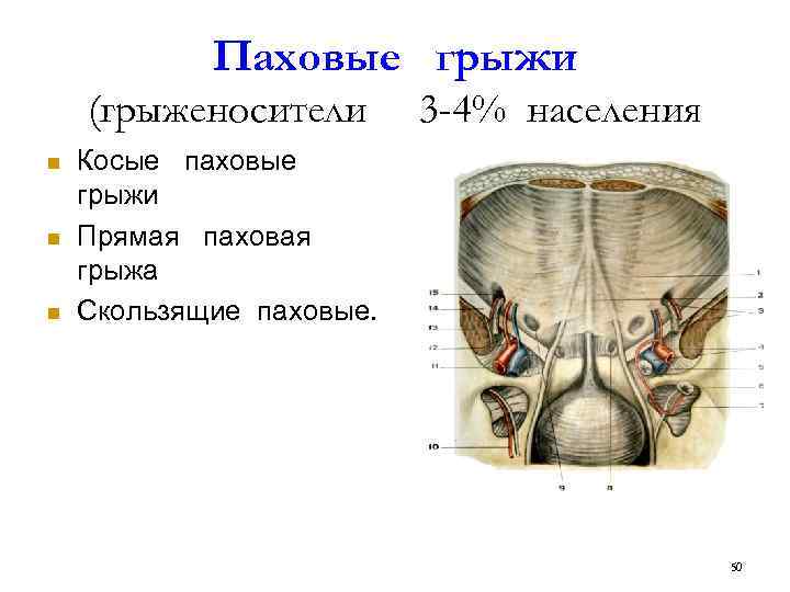 Какая грыжа паховая. Косая и прямая паховая грыжа. Прямые и косые паховые грыжи.