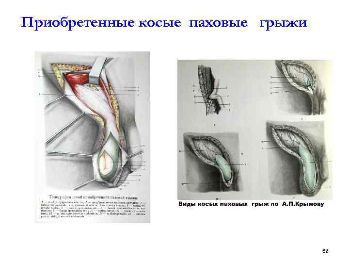 Косая и прямая паховая грыжа отличие. Канатиковая паховая грыжа. Косая паховая грыжа паховая ямка. Косая паховая грыжа анатомия. Правосторонняя косая паховая грыжа.