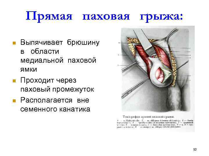 Прямая паховая грыжа: n n n Выпячивает брюшину в области медиальной паховой ямки Проходит