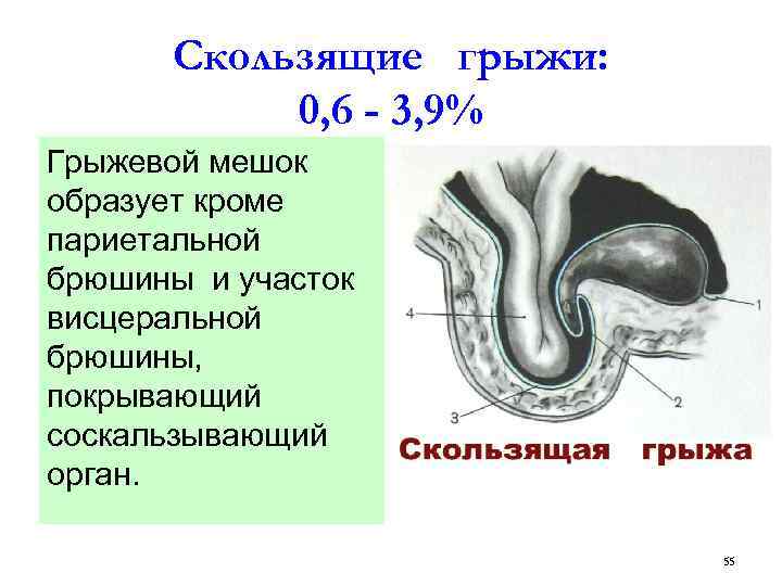 Грыжевой мешок. Скользящая паховая грыжа. Скользящая грыжа схема. Скользящая грыжа передней брюшной стенки. Скользящих паховая грыжах.