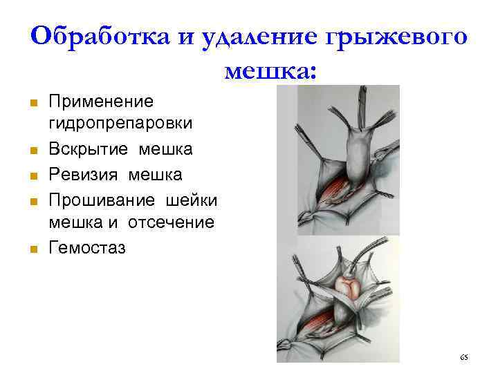 Обработка и удаление грыжевого мешка: n n n Применение гидропрепаровки Вскрытие мешка Ревизия мешка