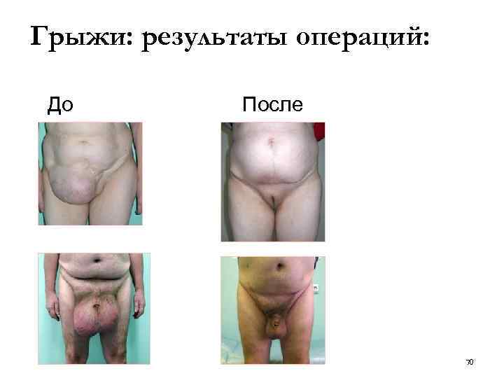 Грыжи: результаты операций: До После 70 